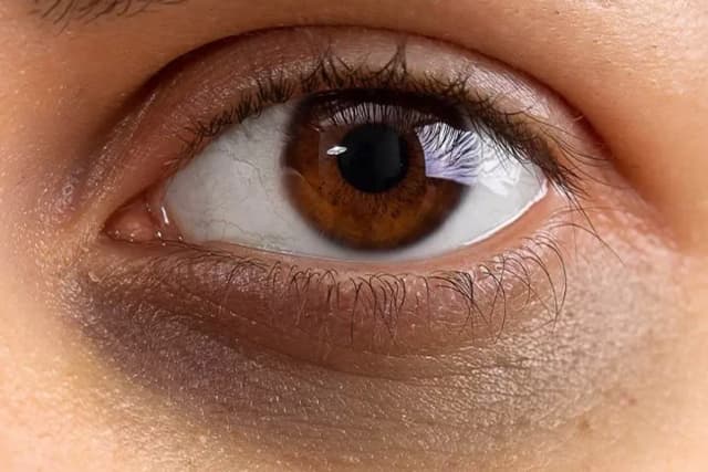 علت تیرگی دور چشم و درمان آن