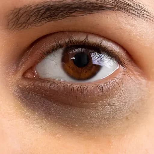 علت تیرگی دور چشم و درمان آن